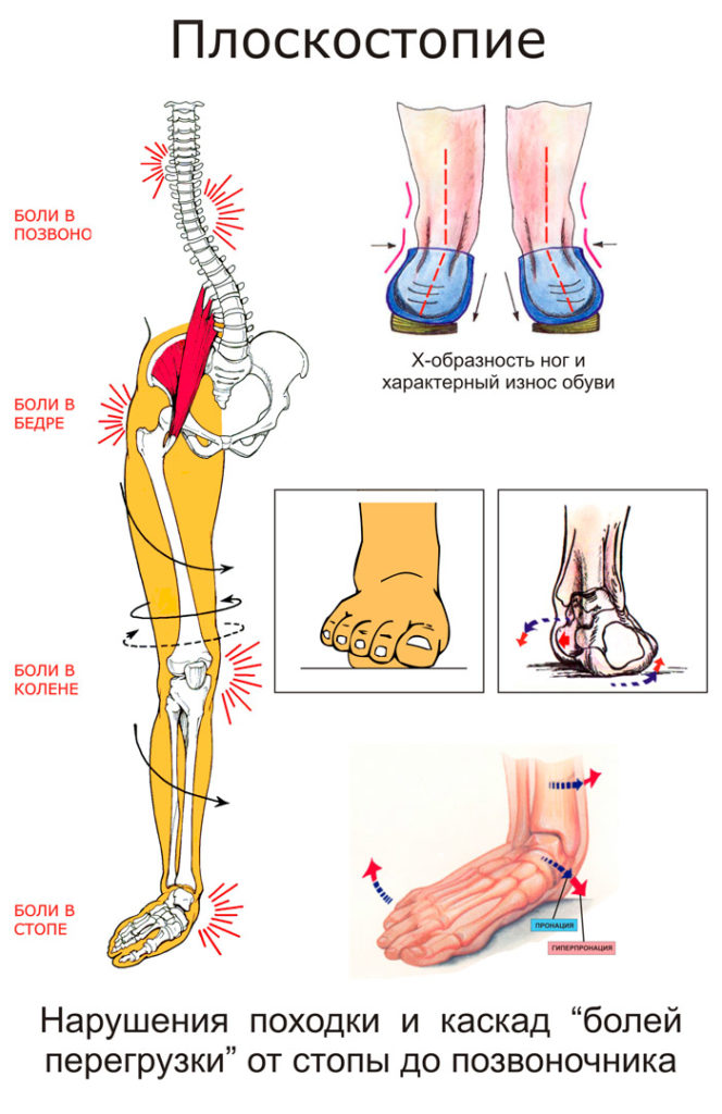 Плоскостопие. Локализация боли при плоскостопии. Степени плоскостопия в градусах. Продольное и поперечное плоскостопие. Тип стопы плоскостопие.